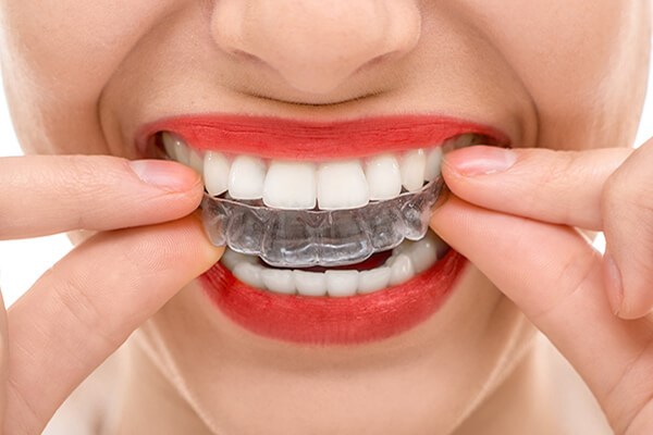 Invisalign Image